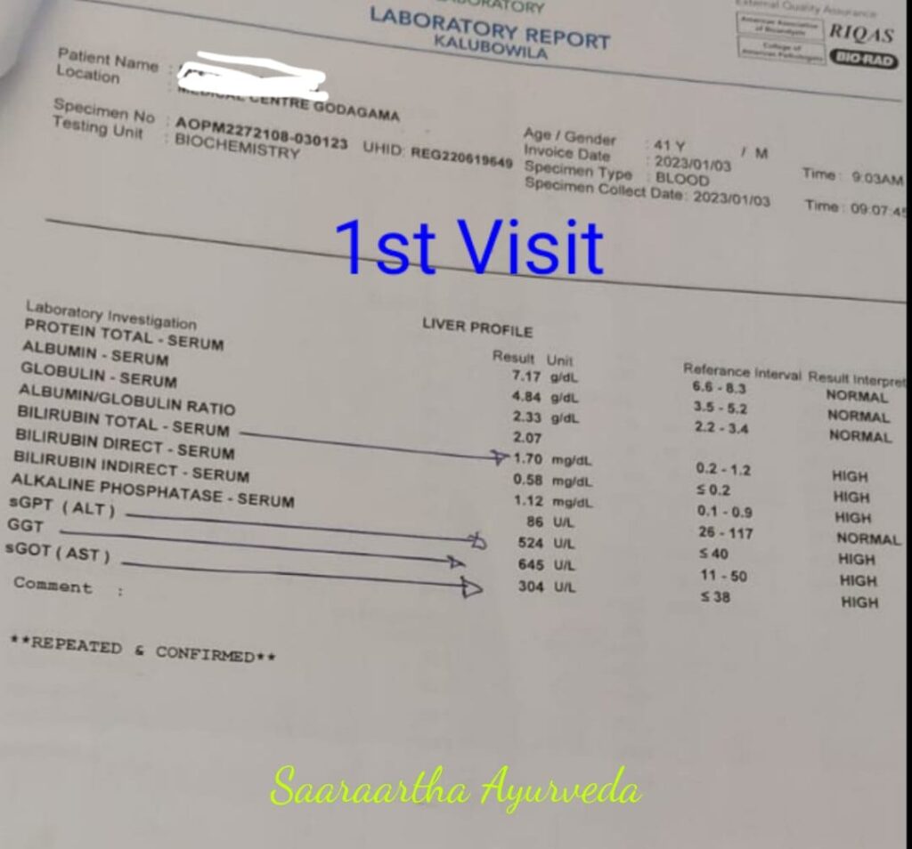 මත්පැන් පානයෙන් (Alcholic Liver Disease) දරුණු ලෙස අක්මාවට හානි වී විදේශගතව සේවය කර ප්‍රතිකාර ලබා ගැනීමට ශ්‍රී ලංකාවට පැමිණි රෝගියාට ආයුර්වේද ප්‍රතිකාරවල ඵලදායිතාව මාසයකට පසු පහත සඳහන් වාර්තා වේ. ප්‍රතිකාර කිරීමට පෙර, ඔහුගේ SGPT, GGT සහ SGOT අගයන් පිළිවෙලින් 524, 645, 304 U/L වූ අතර ප්‍රතිකාර කිරීමෙන් මාසයකට පසු ඒවා 120, 271, 41 U/L දක්වා වේගයෙන් අඩු වී ඇත. බොහෝ රෝග ලක්ෂණ ප්රතිකාර මගින් සමනය විය. මාසයක ප්‍රතිකාර වලින් පසු ඔහු රැකියාවට පිටත්ව ගිය අතර තවමත් ප්‍රතිකාර ලබයි. ඇල්කොලික් අක්මා රෝගය (ALD) ඇති මෙම රෝගීන්ට ප්‍රතිකාර ලබා නොගන්නේ නම්, ඔවුන් සිරෝසිස් / ලිවර් සිරෝසිස් (සීඑල්සීඩී) වර්ධනය වීමේ වැඩි සම්භාවිතාවක් ඇත. ආයුර්වේද ඖෂධ අක්මාවට හානි කරන බවට වැරදි මතයක් පවතී. ශාස්‌ත්‍රය නොදන්නා වෛද්‍යවරු අරිෂ්ඨ, ආසව වැනි ඖෂධ අධික මාත්‍රාවලින් දීර්ඝ කාලයක් ලබා දුන්නොත් පමණයි එහෙම වෙන්නේ... අක්මා රෝග සඳහා සාර්ථක ආයුර්වේද ප්‍රතිකාර තිබෙනවා.