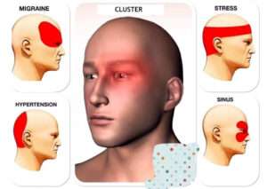 05 Types of Headaches: Causes, Symptoms, and Treatment.